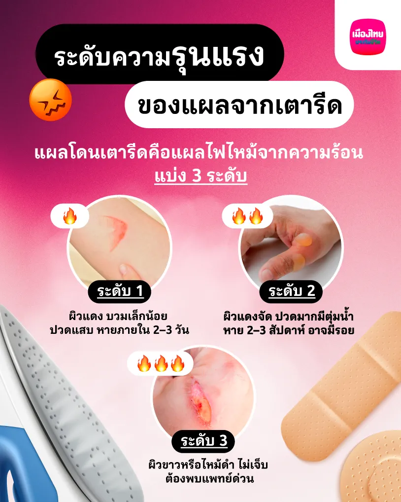 ระดับความรุนแรงของแผลจากเตารีด